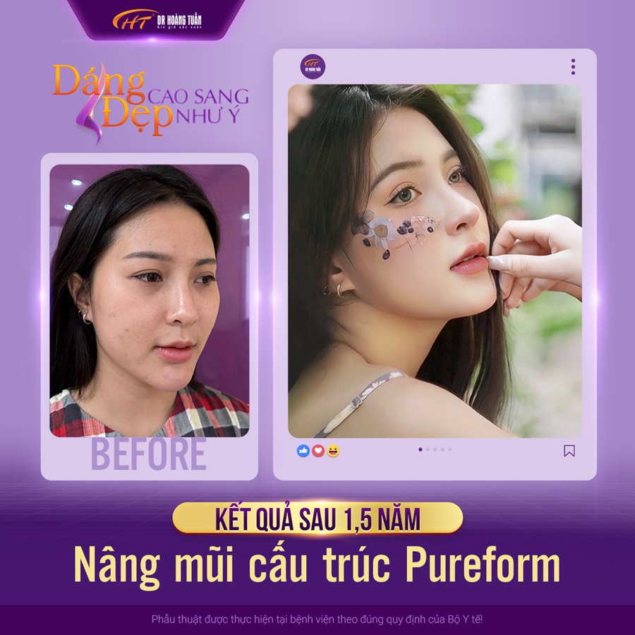 Sụn sinh học surgiform trong nâng mũi cấu trúc Pureform Hoàng Tuấn